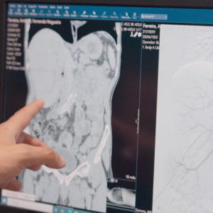Termoablação por radiofrequência de metastase hepática