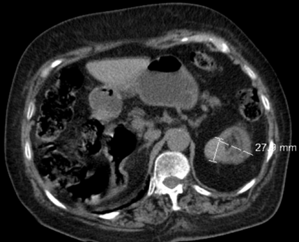 Crioablação Percutânea de tumor renal