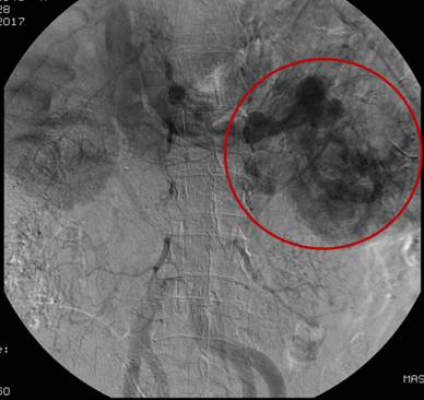 Embolização Renal com acesso radial