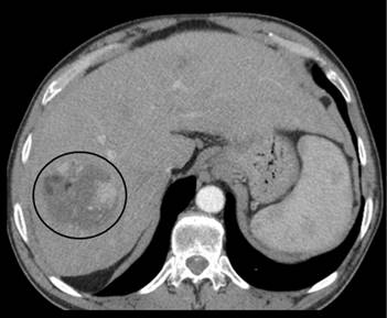 Quimiembolização de Hepatocarcinoma